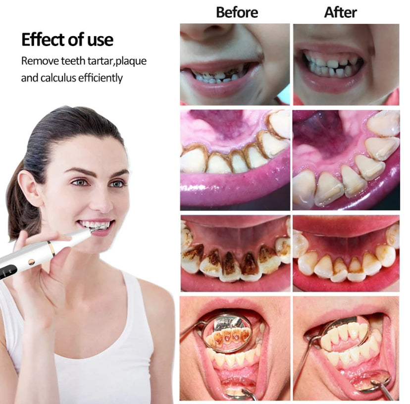 G6 Ultrasonic Dental Calculus Remover Teeth